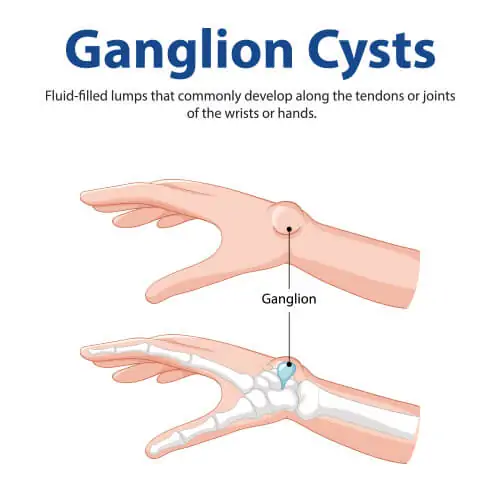 Underlying Health Issues That Affect the Wrist