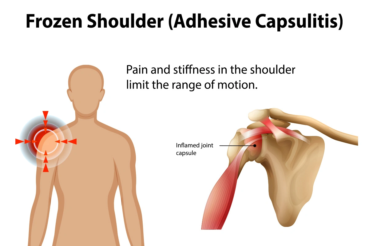 the science behind frozen shoulder