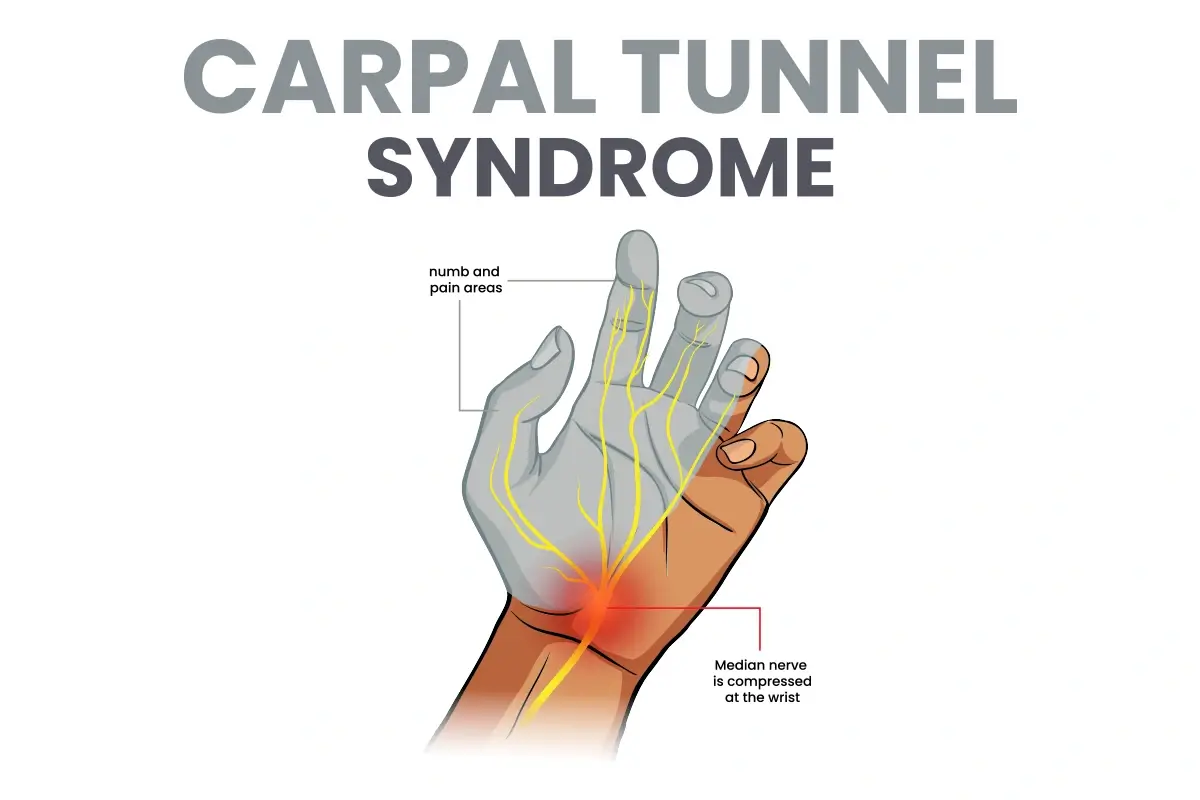 ipamorelin side effects carpal tunnel syndrome Carpal Tunnel Syndrome: Causes, Symptoms & Hand Pain Relief