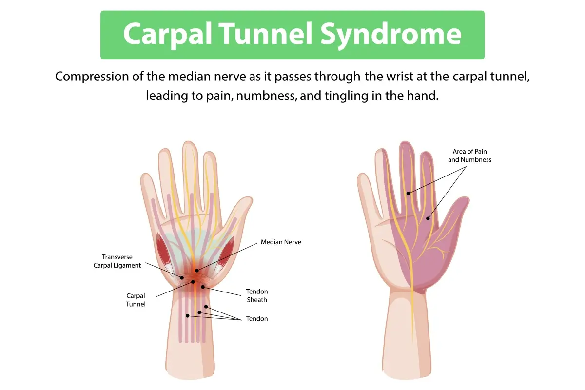 ipamorelin side effects carpal tunnel syndrome Carpal Tunnel Syndrome: Causes, Symptoms & Hand Pain Relief