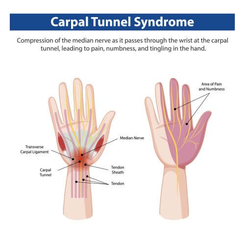 Carpal tunnel Syndrome