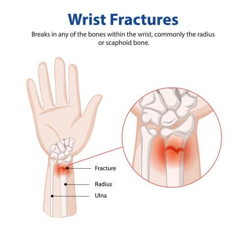 Fractures, ligament tears, sprains and strains.